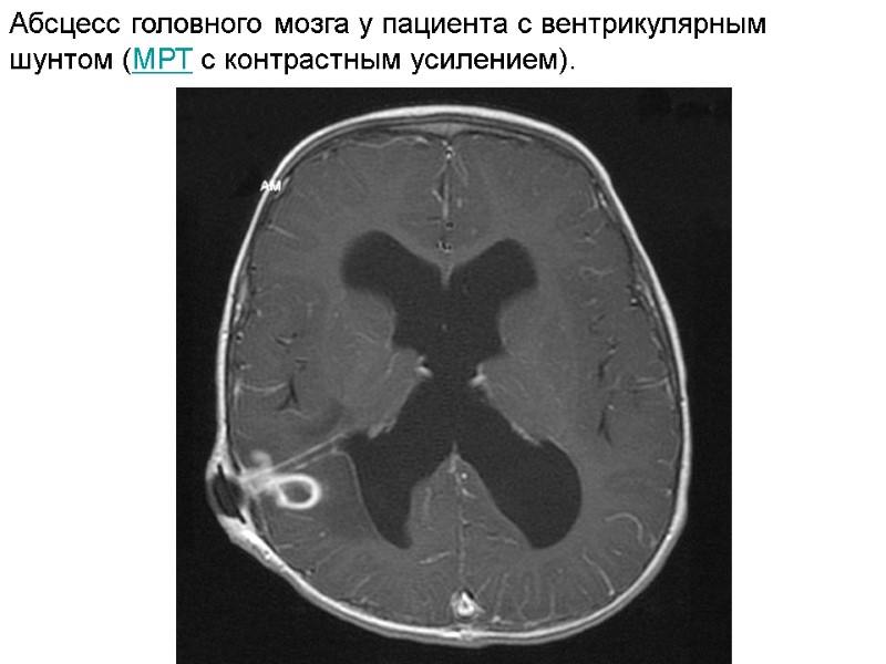 Абсцесс головного мозга у пациента с вентрикулярным шунтом (МРТ с контрастным усилением).